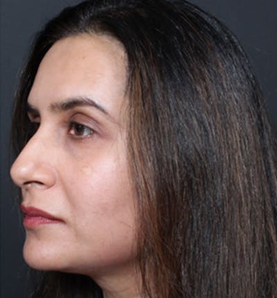 Injectables Before & After Gallery - Patient 14089655 - Image 1