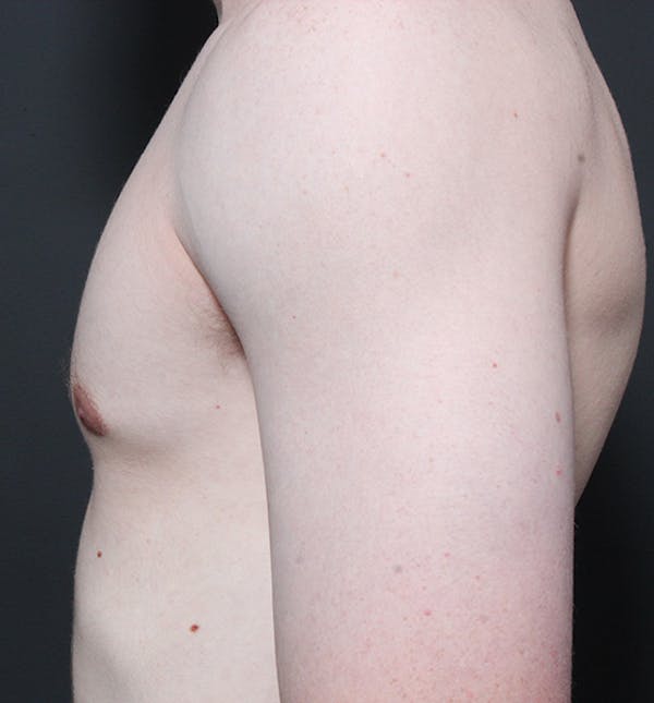 Male Chest Reduction Before & After Gallery - Patient 14089646 - Image 6