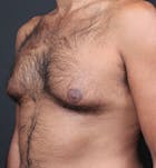 Male Chest Reduction Before & After Gallery - Patient 14089652 - Image 1