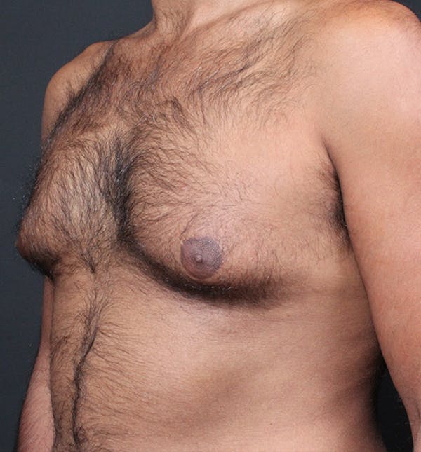Male Chest Reduction Before & After Gallery - Patient 14089652 - Image 1