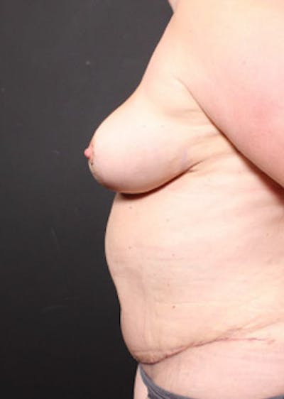 Breast Reduction Gallery - Patient 14089649 - Image 6