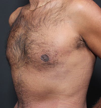 Male Chest Reduction Before & After Gallery - Patient 14089652 - Image 2