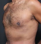 Male Chest Reduction Before & After Gallery - Patient 14089652 - Image 2