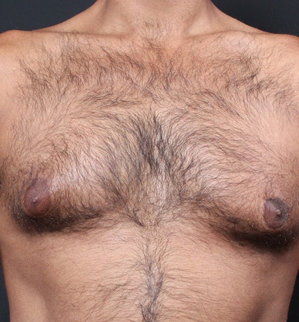 Male Chest Reduction Before & After Gallery - Patient 14089652 - Image 3