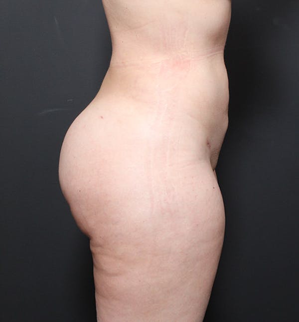 Brazilian Butt Lift Gallery - Patient 14089654 - Image 6