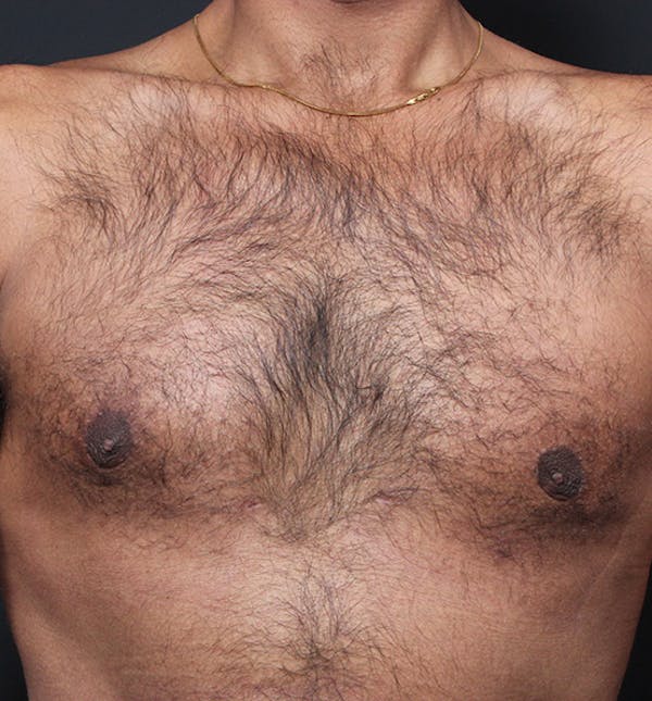 Male Chest Reduction Before & After Gallery - Patient 14089652 - Image 4