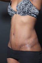 Tummy Tuck Before & After Gallery - Patient 14089669 - Image 2