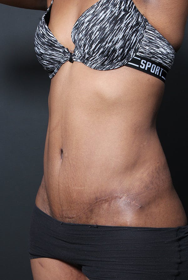Tummy Tuck Gallery - Patient 14089669 - Image 2