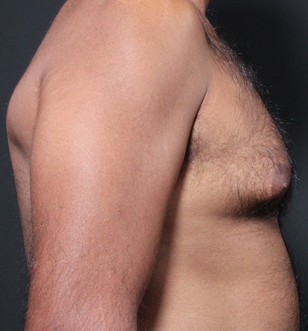 Male Chest Reduction Before & After Gallery - Patient 14089652 - Image 5