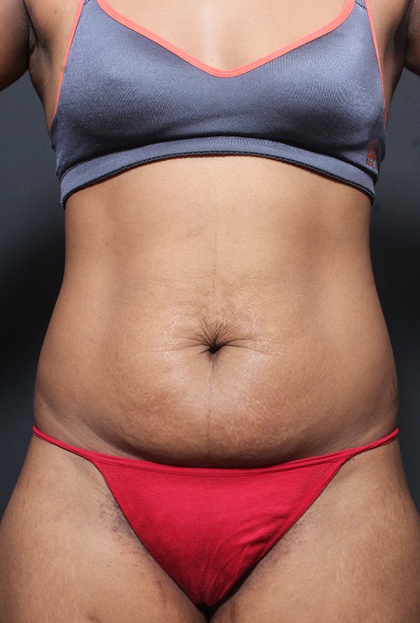 Tummy Tuck Before & After Gallery - Patient 14089669 - Image 3