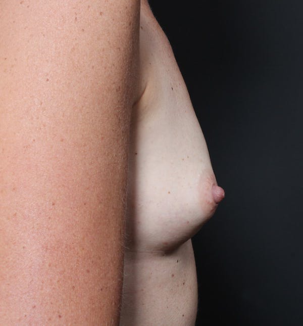 Breast Augmentation Before & After Gallery - Patient 14089658 - Image 7