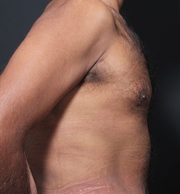 Male Chest Reduction Before & After Gallery - Patient 14089652 - Image 6