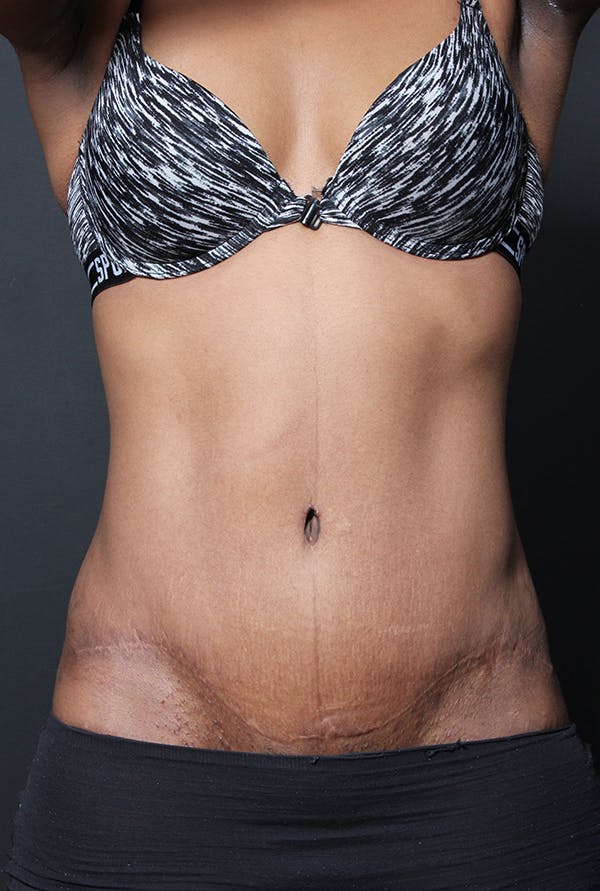 Tummy Tuck Gallery - Patient 14089669 - Image 4