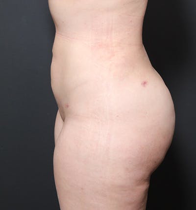 Brazilian Butt Lift Before & After Gallery - Patient 14089654 - Image 10