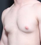 Male Chest Reduction Before & After Gallery - Patient 14089664 - Image 1
