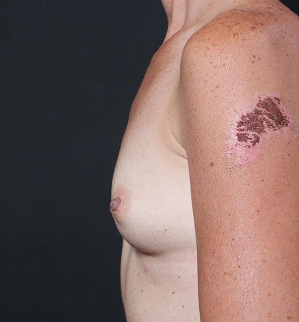 Breast Augmentation Before & After Gallery - Patient 14089658 - Image 9