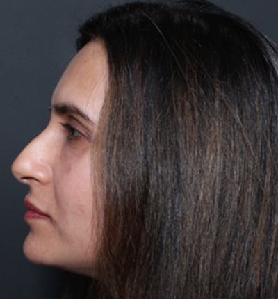 Injectables Before & After Gallery - Patient 14089655 - Image 10