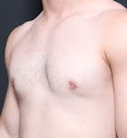 Male Chest Reduction Before & After Gallery - Patient 14089664 - Image 2