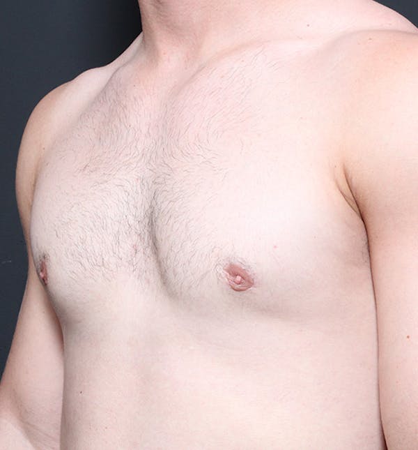 Male Chest Reduction Before & After Gallery - Patient 14089664 - Image 2