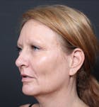Injectables Before & After Gallery - Patient 14089671 - Image 1