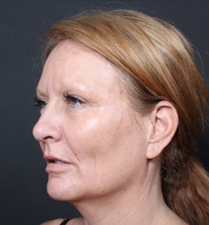 Dermal Fillers