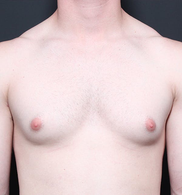Male Chest Reduction Before & After Gallery - Patient 14089664 - Image 3