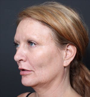 Dermal Fillers