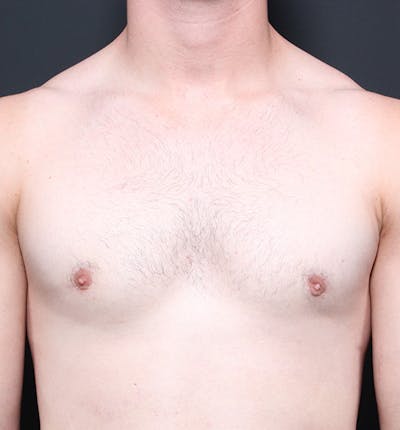 Male Chest Reduction Before & After Gallery - Patient 14089664 - Image 4