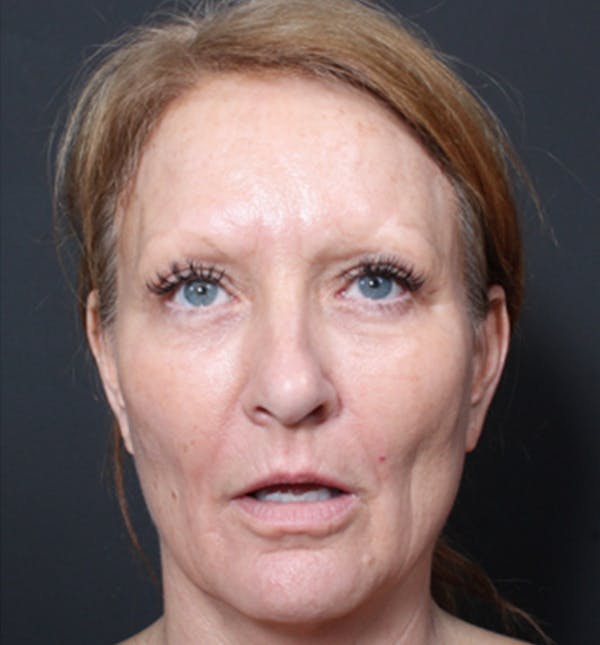 Injectables Before & After Gallery - Patient 14089671 - Image 3