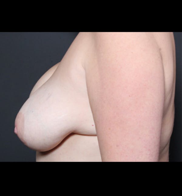 Breast Implant Revision Before & After Gallery - Patient 14089668 - Image 5