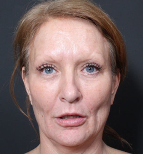 Injectables Before & After Gallery - Patient 14089671 - Image 4
