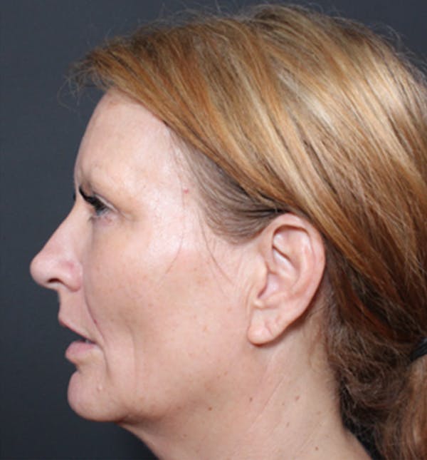 Injectables Before & After Gallery - Patient 14089671 - Image 5