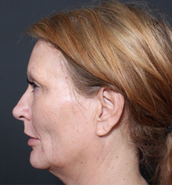 Injectables Before & After Gallery - Patient 14089671 - Image 6