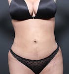 Liposuction Before & After Gallery - Patient 76764929 - Image 2