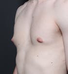 Male Chest Reduction Gallery - Patient 14089676 - Image 1