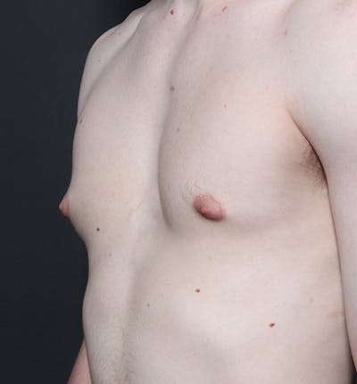 Male Chest Reduction Before & After Gallery - Patient 14089676 - Image 1