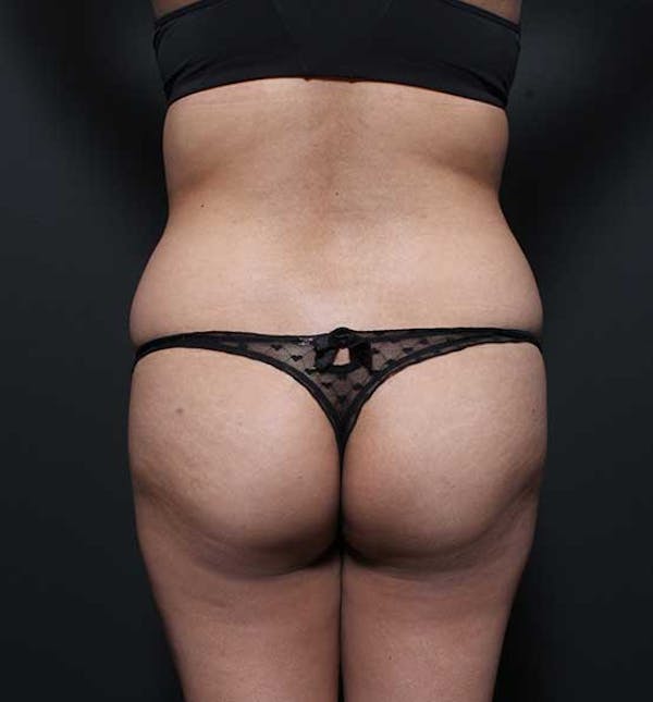 Brazilian Butt Lift Before & After Gallery - Patient 14089674 - Image 9