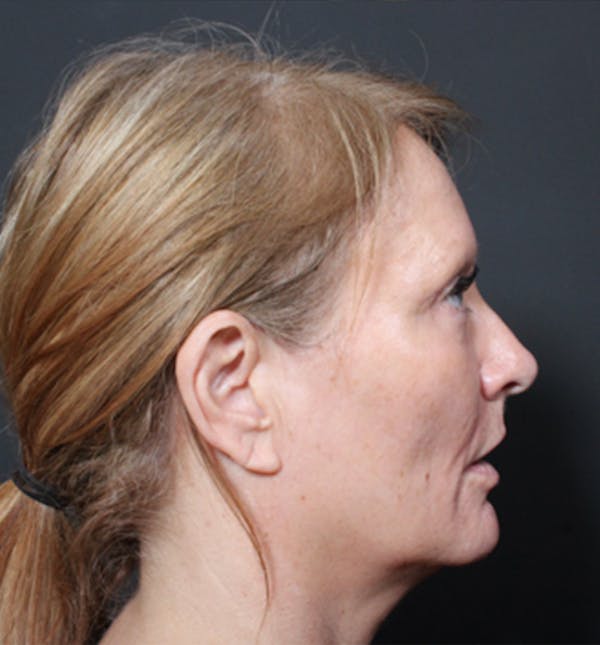 Injectables Before & After Gallery - Patient 14089671 - Image 7