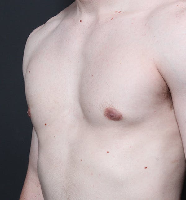 Male Chest Reduction Before & After Gallery - Patient 14089676 - Image 2