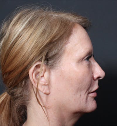 Injectables Before & After Gallery - Patient 14089671 - Image 8