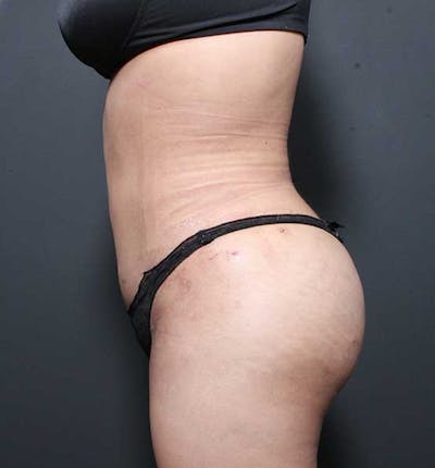 Brazilian Butt Lift Before & After Gallery - Patient 14089674 - Image 12