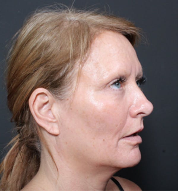 Injectables Before & After Gallery - Patient 14089671 - Image 9
