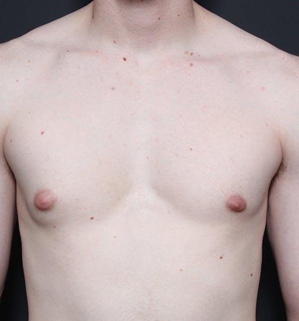 Male Chest Reduction Before & After Gallery - Patient 14089676 - Image 3