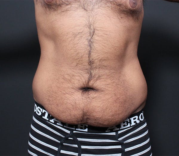 Male Tummy Tuck Before & After Gallery - Patient 14089675 - Image 3