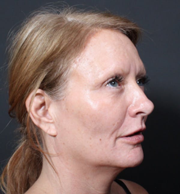 Injectables Before & After Gallery - Patient 14089671 - Image 10
