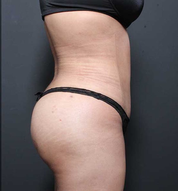 Brazilian Butt Lift Before & After Gallery - Patient 14089674 - Image 14