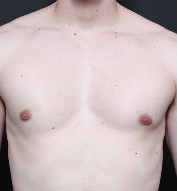 Male Chest Reduction Before & After Gallery - Patient 14089676 - Image 4