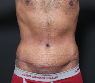 Male Tummy Tuck Before & After Gallery - Patient 14089675 - Image 4