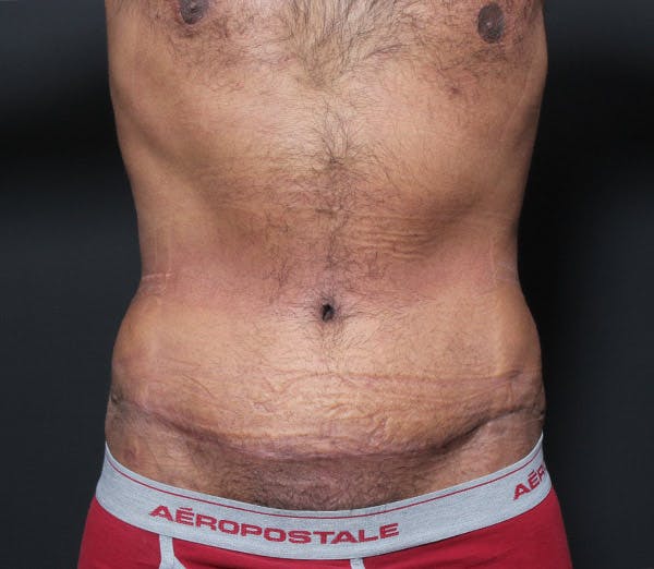 Male Tummy Tuck Before & After Gallery - Patient 14089675 - Image 4
