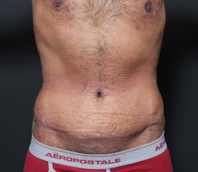 Male Tummy Tuck Gallery - Patient 14089675 - Image 4